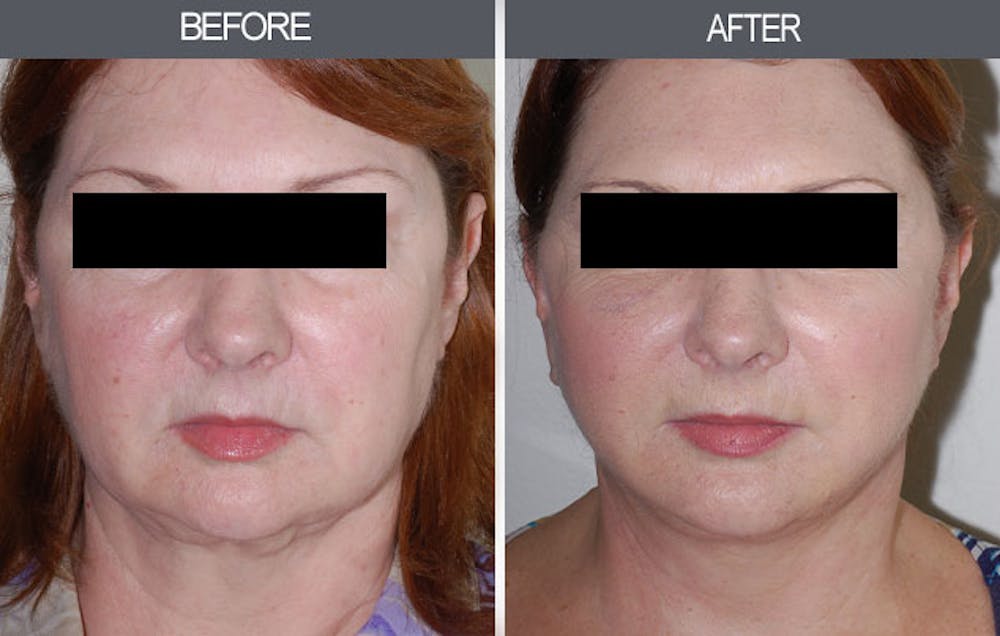Facelift Before & After Gallery - Patient 4449146 - Image 1