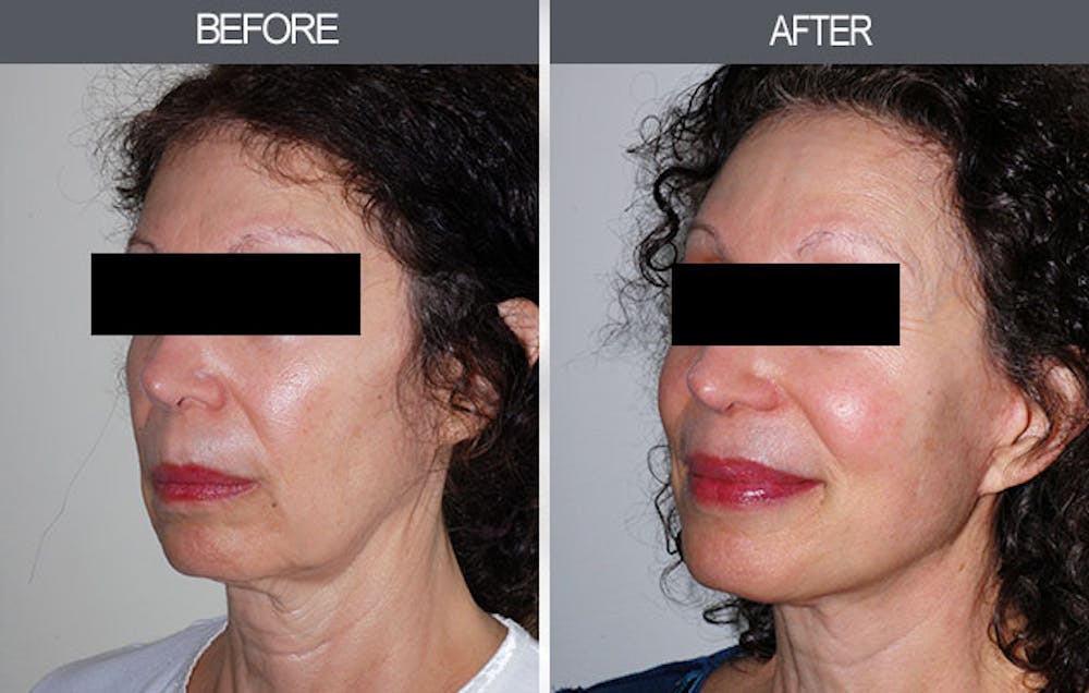 Facelift and Mini Facelift Gallery Before & After Gallery - Patient 4449145 - Image 3