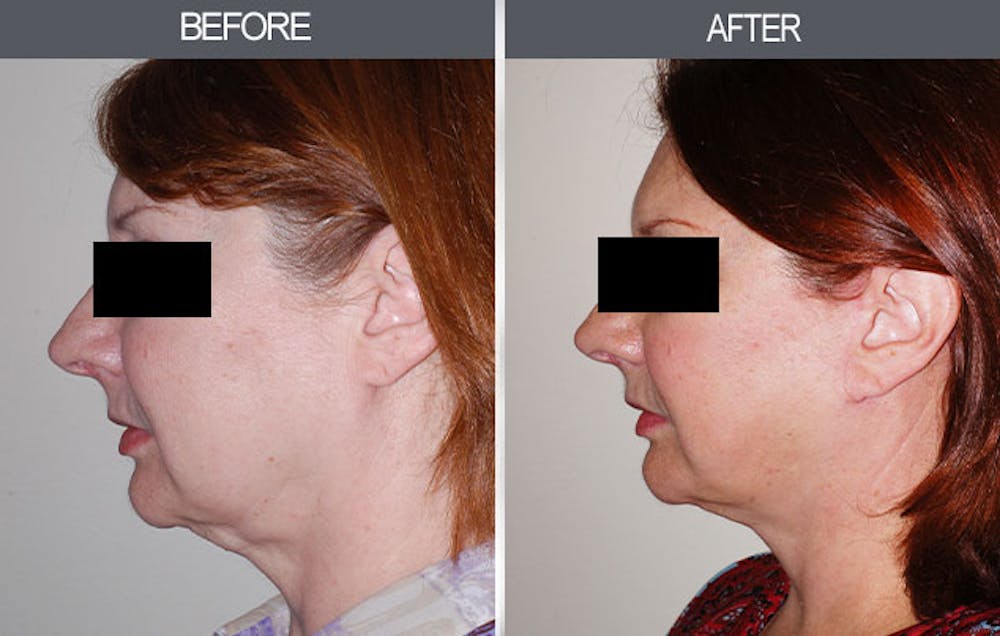 Facelift and Mini Facelift Before & After Gallery - Patient 4449146 - Image 2