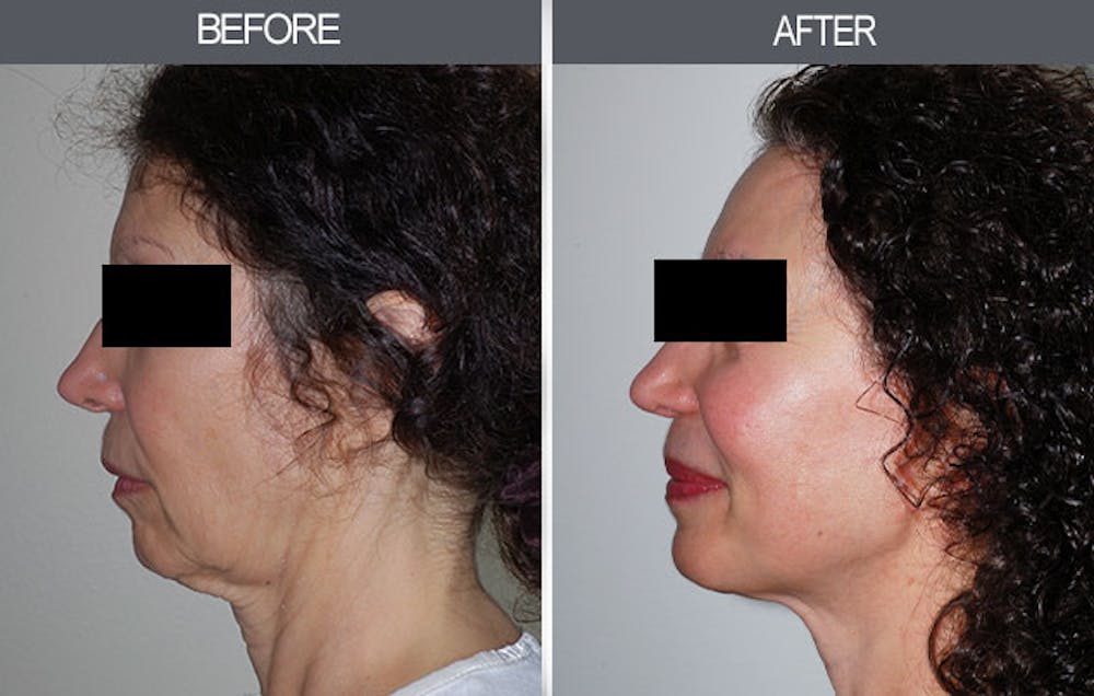 Facelift and Mini Facelift Before & After Gallery - Patient 4449145 - Image 4