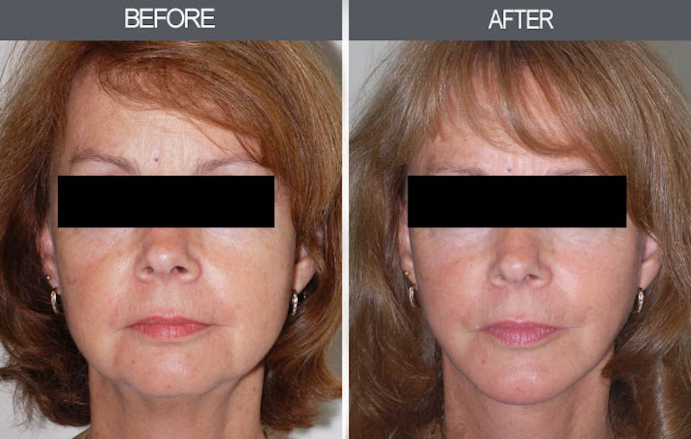 Facelift Before & After Gallery - Patient 4449147 - Image 1