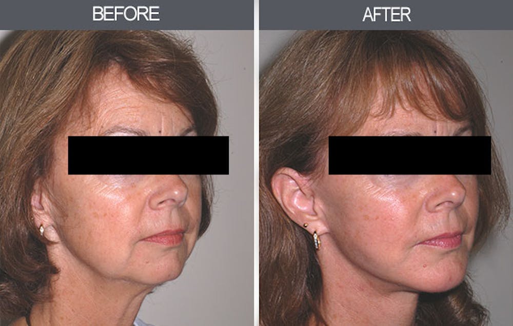Facelift and Mini Facelift Gallery Before & After Gallery - Patient 4449147 - Image 2