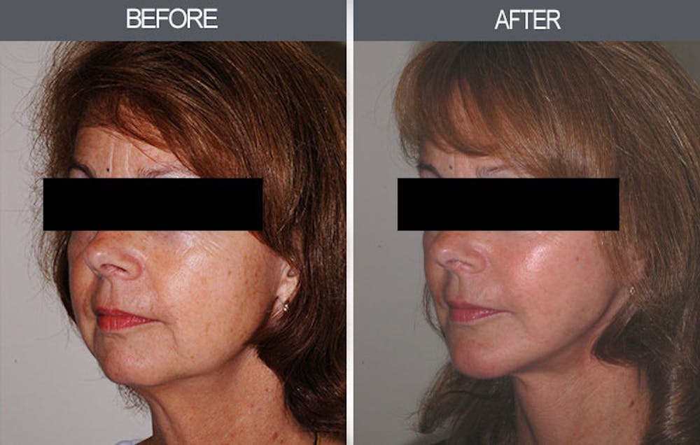 Facelift and Mini Facelift Gallery Before & After Gallery - Patient 4449147 - Image 3
