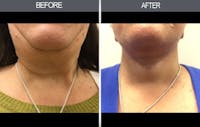 Facelift and Mini Facelift Gallery Before & After Gallery - Patient 4449148 - Image 1