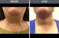 Facelift Before & After Gallery - Patient 4449148 - Image 1