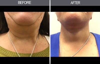 Facelift and Mini Facelift Gallery Before & After Gallery - Patient 4449148 - Image 1