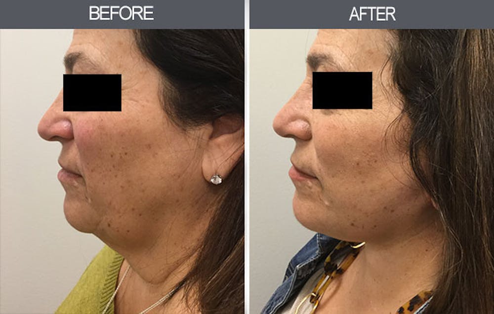 Facelift and Mini Facelift Gallery Before & After Gallery - Patient 4449148 - Image 2