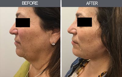 Facelift and Mini Facelift Gallery Before & After Gallery - Patient 4449148 - Image 2