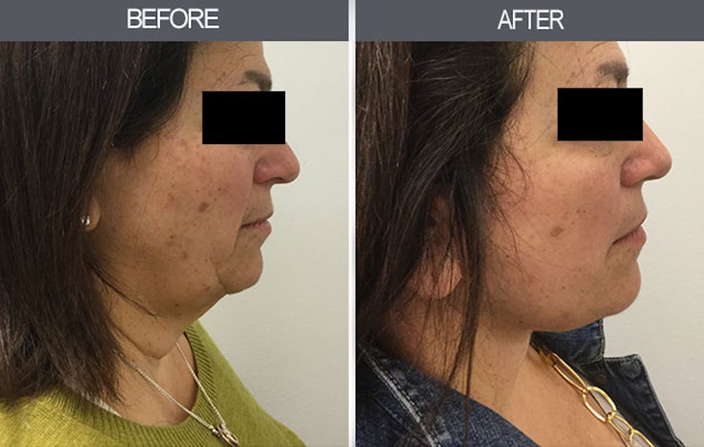 Facelift and Mini Facelift Gallery Before & After Gallery - Patient 4449148 - Image 3