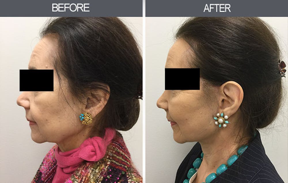 Facelift Before & After Gallery - Patient 4449149 - Image 1