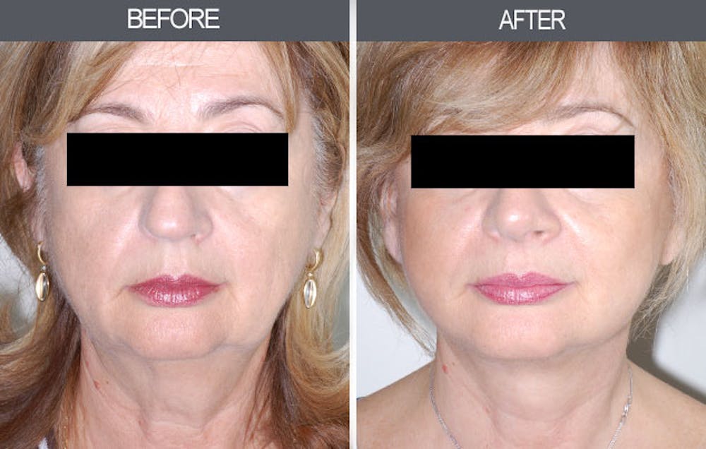 Facelift and Mini Facelift Gallery Before & After Gallery - Patient 4449150 - Image 1