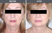 Facelift and Mini Facelift Gallery Before & After Gallery - Patient 4449150 - Image 1