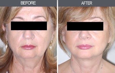 Facelift and Mini Facelift Gallery Before & After Gallery - Patient 4449150 - Image 1