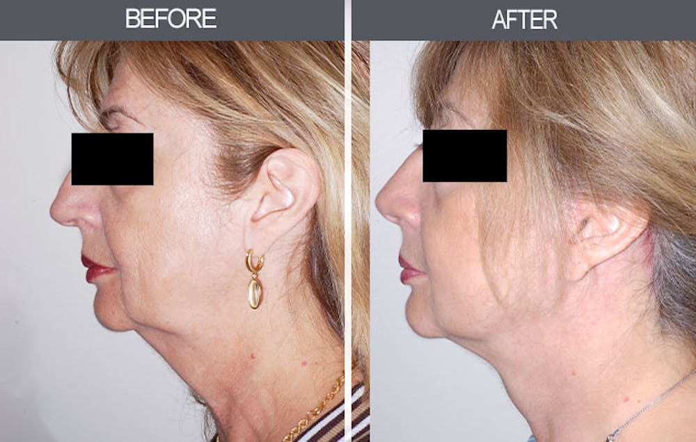 Facelift Before & After Gallery - Patient 4449150 - Image 2