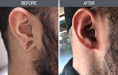 Earlobe Repair Gallery Before & After Gallery - Patient 4450473 - Image 1