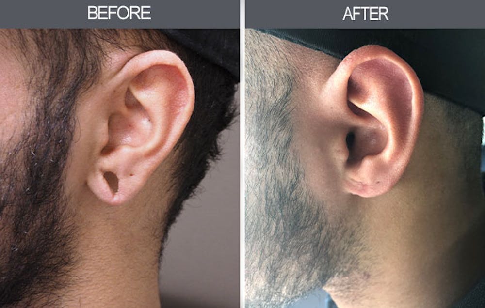 Earlobe Repair Gallery Before & After Gallery - Patient 4450473 - Image 2