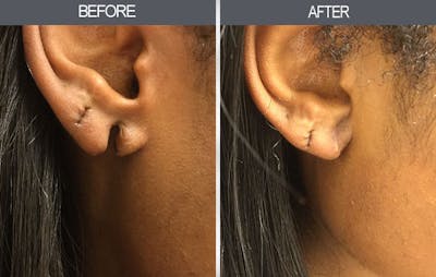 Earlobe Repair Gallery Before & After Gallery - Patient 4450474 - Image 1