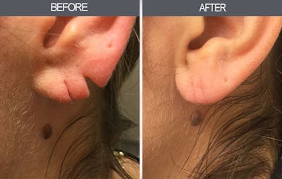 Earlobe Repair Gallery Before & After Gallery - Patient 4450475 - Image 1