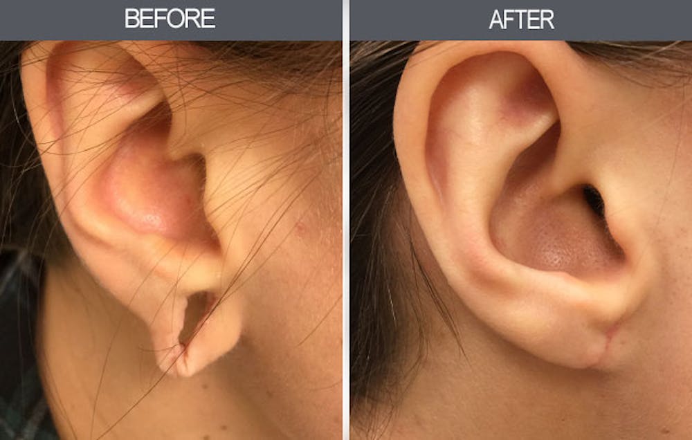 Earlobe Repair Gallery Before & After Gallery - Patient 4450476 - Image 1