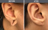 Earlobe Repair Gallery Before & After Gallery - Patient 4450476 - Image 1