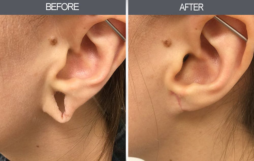 Earlobe Repair Gallery Before & After Gallery - Patient 4450476 - Image 2