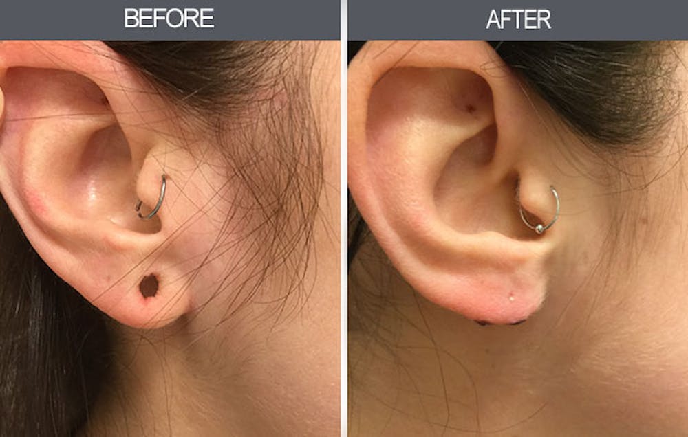 Earlobe Repair Gallery Before & After Gallery - Patient 4450477 - Image 1