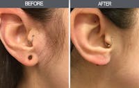 Earlobe Repair Gallery Before & After Gallery - Patient 4450477 - Image 1