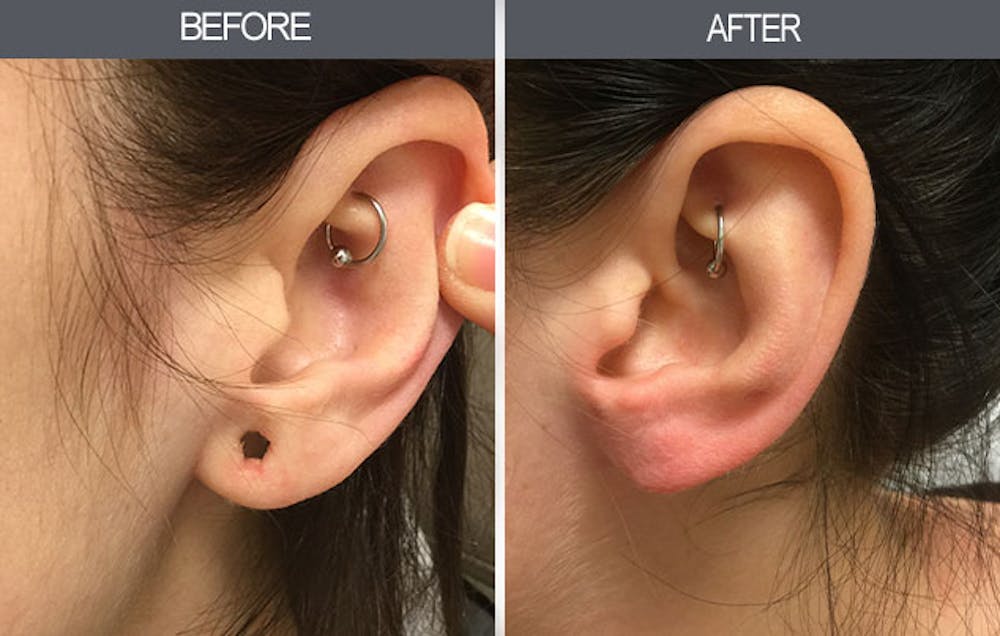 Earlobe Repair Gallery Before & After Gallery - Patient 4450477 - Image 2