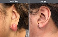 Earlobe Repair Gallery Before & After Gallery - Patient 4450478 - Image 1