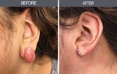 Earlobe Repair Gallery Before & After Gallery - Patient 4450478 - Image 1