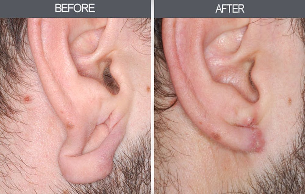 Earlobe Repair Gallery Before & After Gallery - Patient 4450479 - Image 1