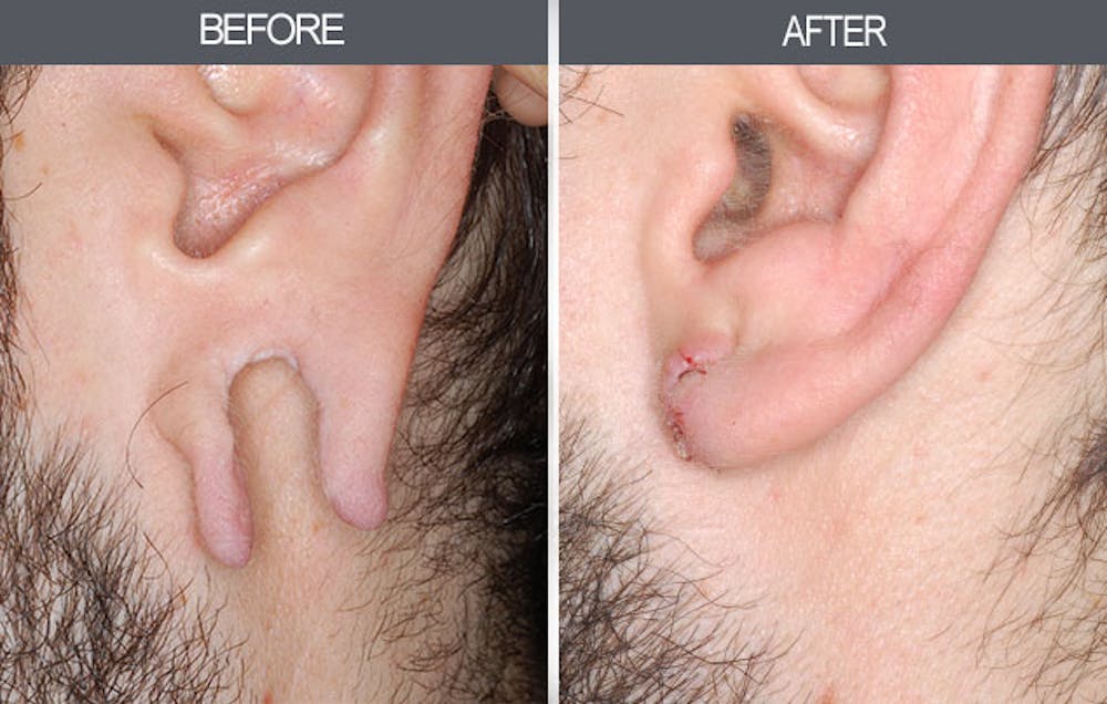 Earlobe Repair Gallery Before & After Gallery - Patient 4450479 - Image 2