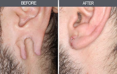 Earlobe Repair Gallery Before & After Gallery - Patient 4450479 - Image 2