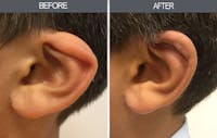 Earlobe Repair Gallery Before & After Gallery - Patient 4450480 - Image 1