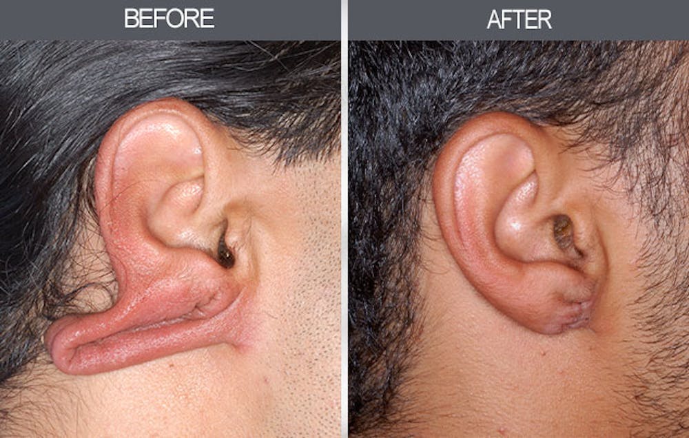 Earlobe Repair Gallery Before & After Gallery - Patient 4450481 - Image 1