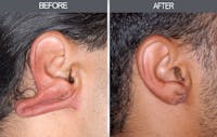 Earlobe Repair Gallery Before & After Gallery - Patient 4450481 - Image 1