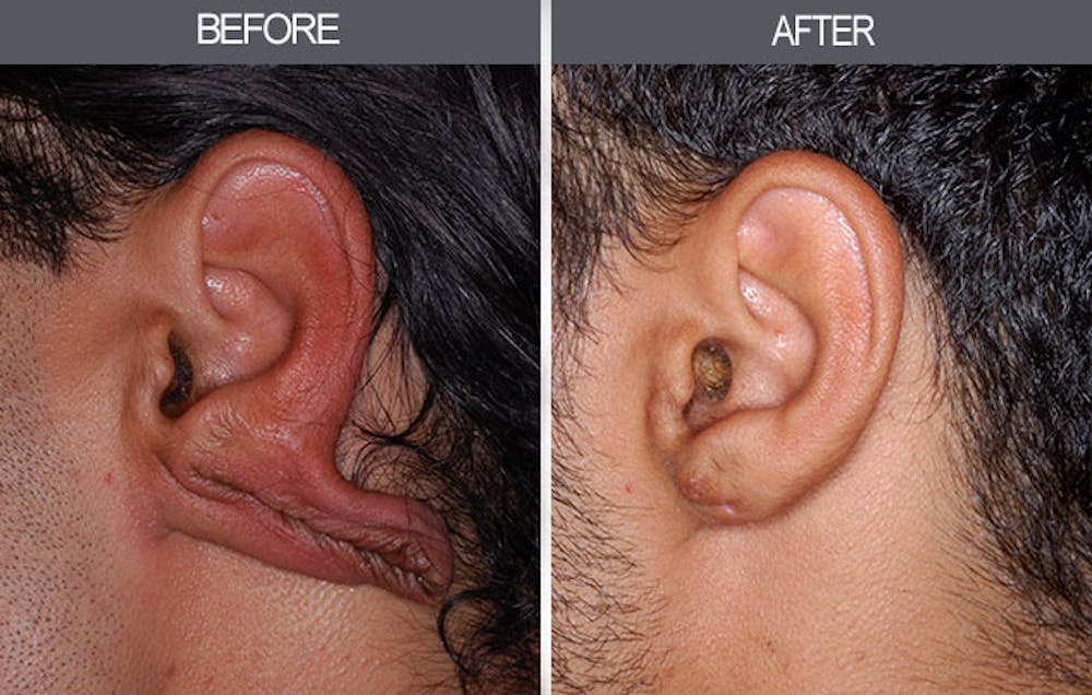 Earlobe Repair Gallery Before & After Gallery - Patient 4450481 - Image 2