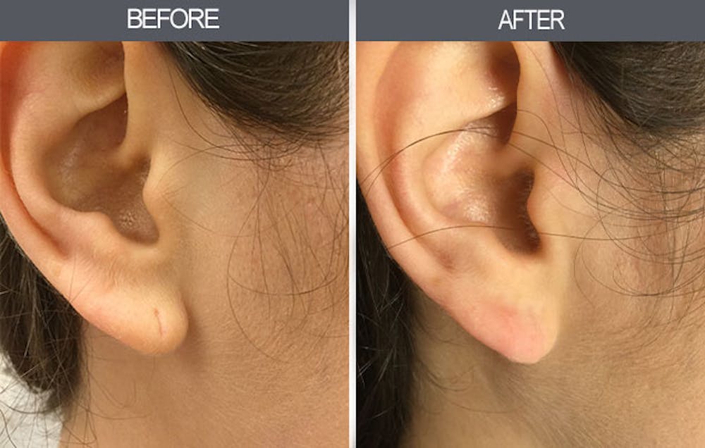 Earlobe Repair Gallery Before & After Gallery - Patient 4450482 - Image 1