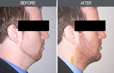 Chin Implants Gallery Before & After Gallery - Patient 4452263 - Image 1