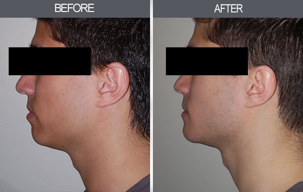 Chin Implants Before & After Gallery - Patient 4452264 - Image 1
