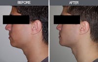Chin Implants Gallery Before & After Gallery - Patient 4452264 - Image 1