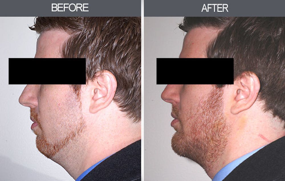Chin Implants Gallery Before & After Gallery - Patient 4452263 - Image 3