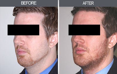 Chin Implants Gallery Before & After Gallery - Patient 4452263 - Image 4