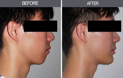 Chin Implants Gallery Before & After Gallery - Patient 4452265 - Image 1