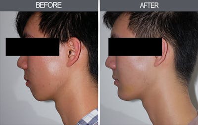 Chin Implants Gallery Before & After Gallery - Patient 4452265 - Image 2