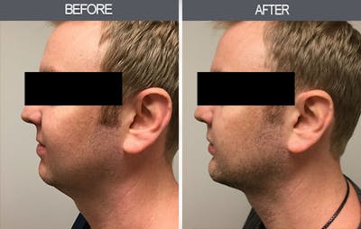 Chin Implants Before & After Gallery - Patient 4452266 - Image 1