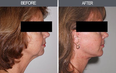 Chin Implants Gallery Before & After Gallery - Patient 4452267 - Image 1
