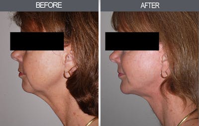 Chin Implants Before & After Gallery - Patient 4452267 - Image 2