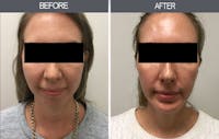 Chin Implants Before & After Gallery - Patient 4452268 - Image 1