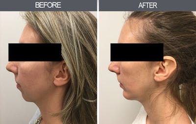 Chin Implants Gallery Before & After Gallery - Patient 4452268 - Image 1